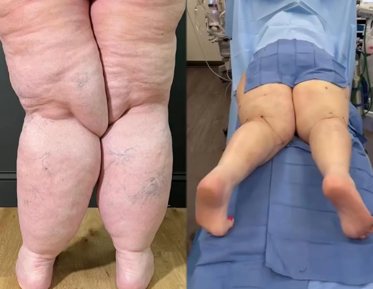 Lipœdème des jambes – avant / après WAL – photo 5